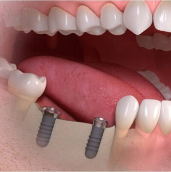 colocación de un implante dental