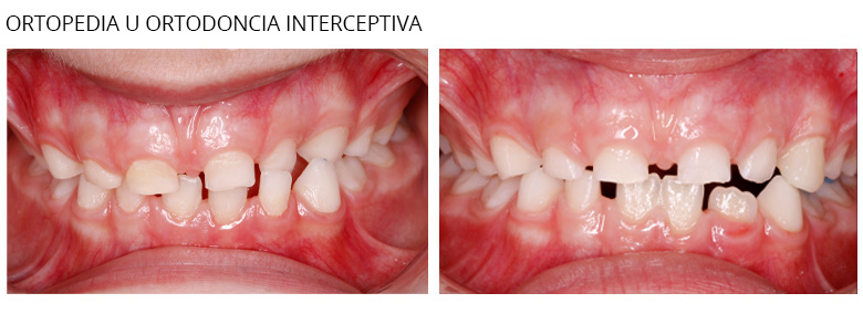 ortodoncia interceptiva
